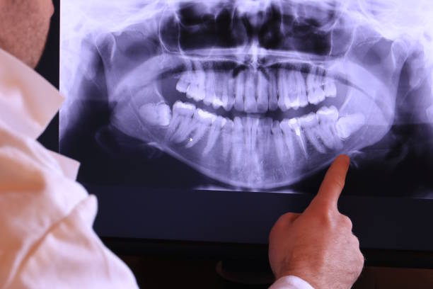 Best Emergency Wisdom Teeth Removal in Girard, OH