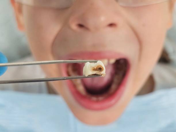 Best Emergency Dental Care for Broken or Chipped Teeth in Girard, OH